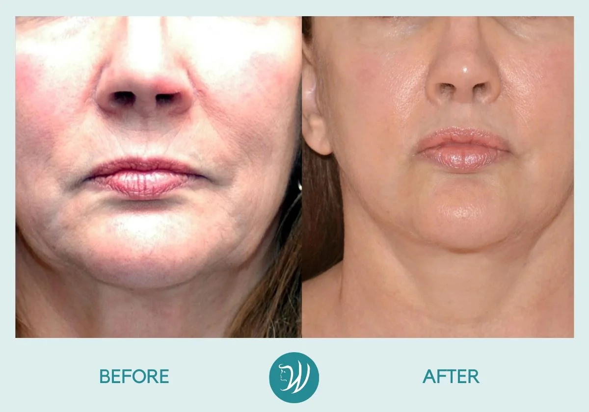 Lip Rejuvenation - Before and After