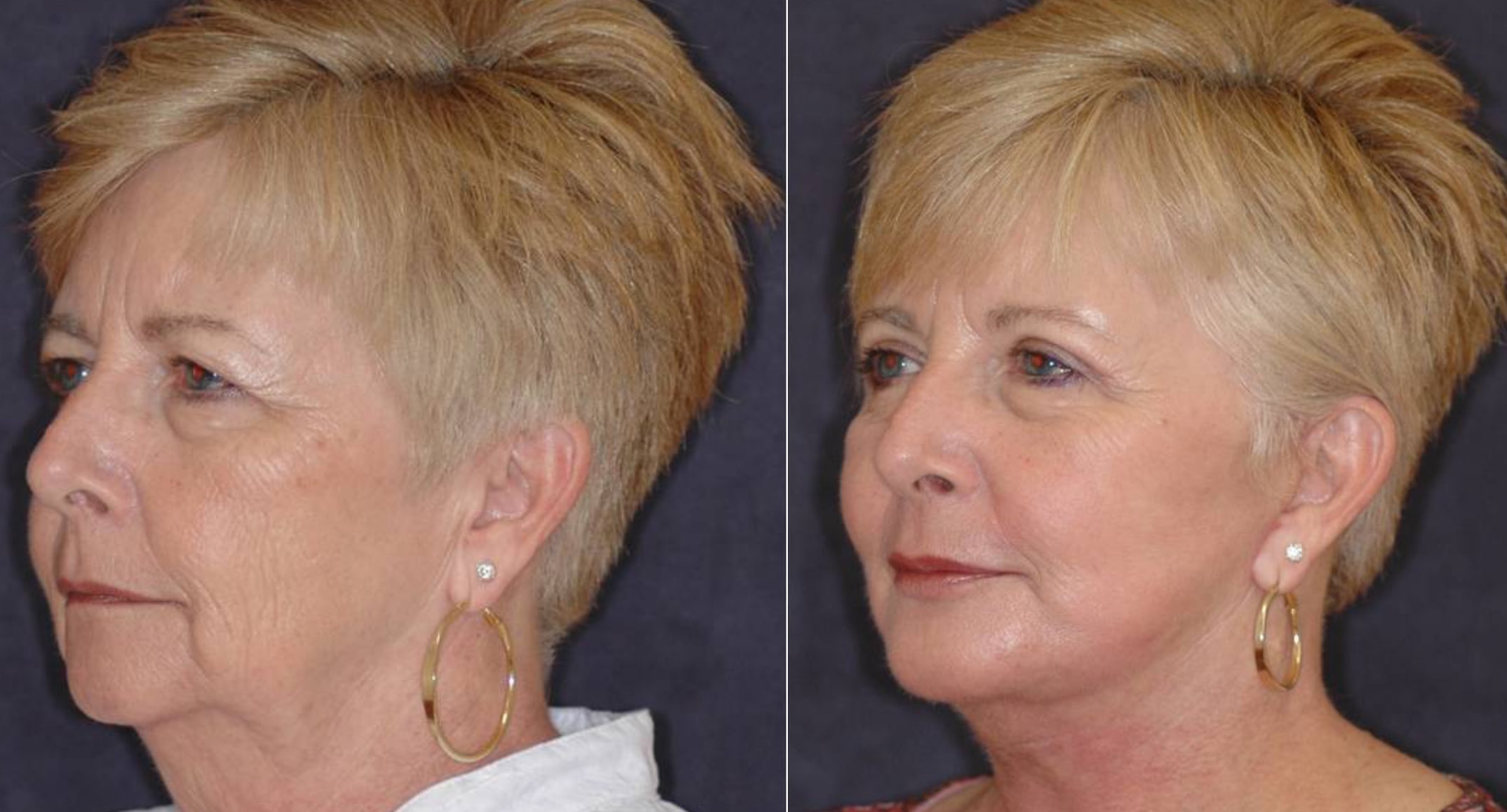 Lower facelift - before and after