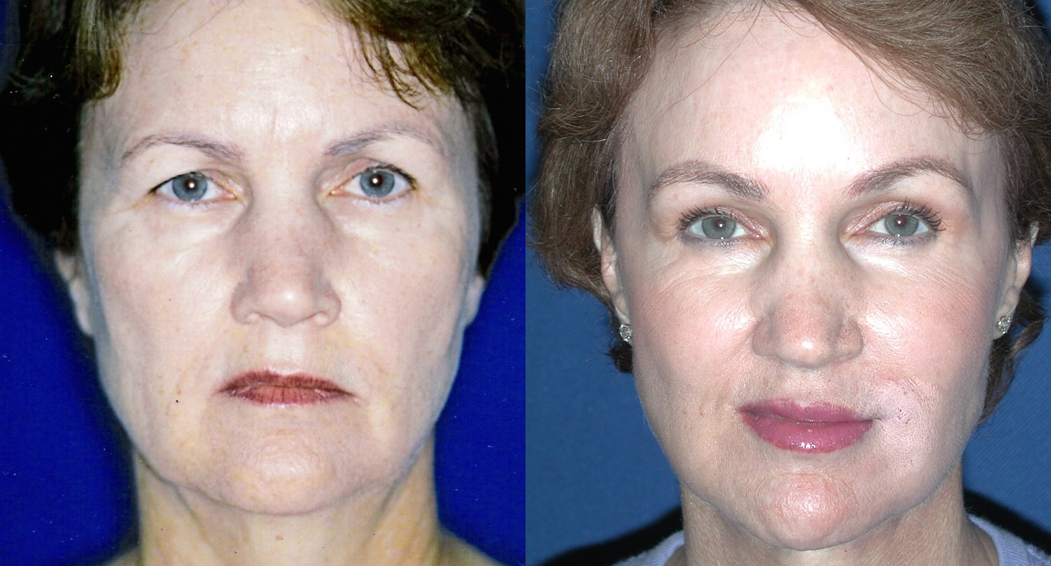 Lower facelift - before and after