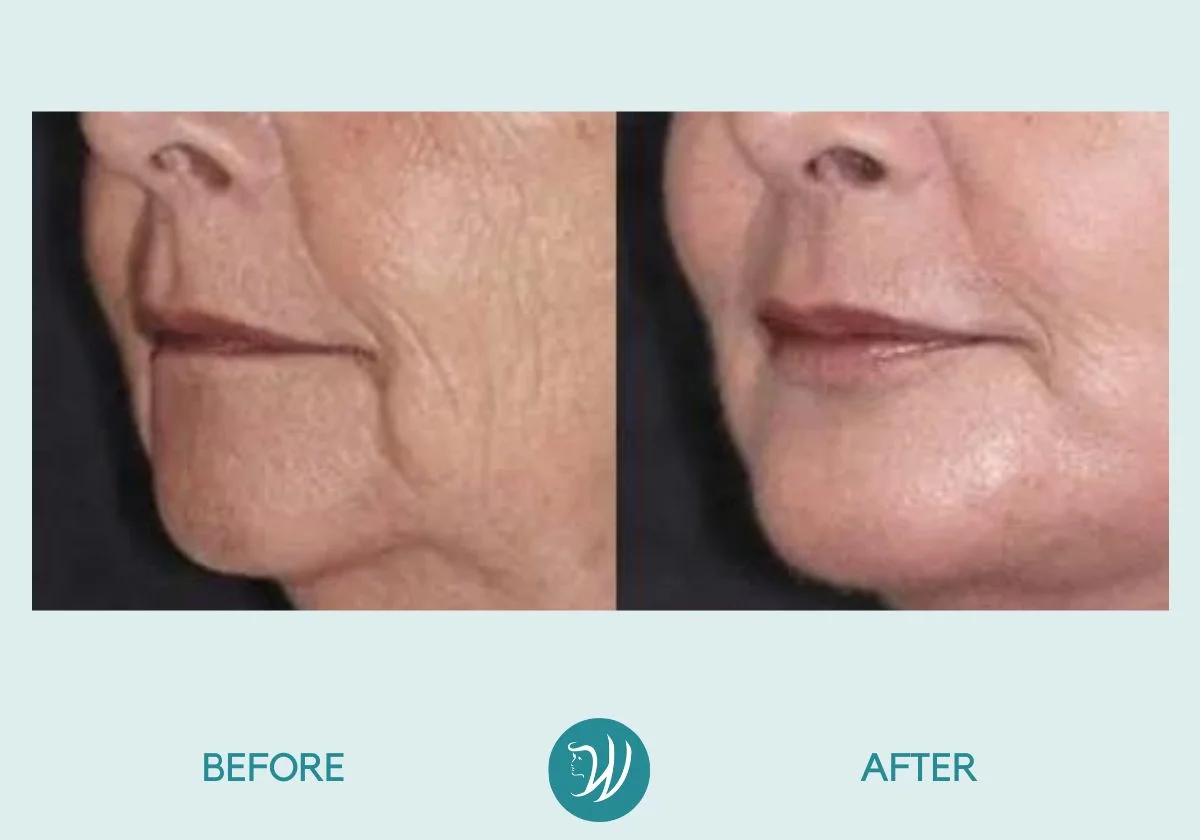 Lip Rejuvenation - Before and After