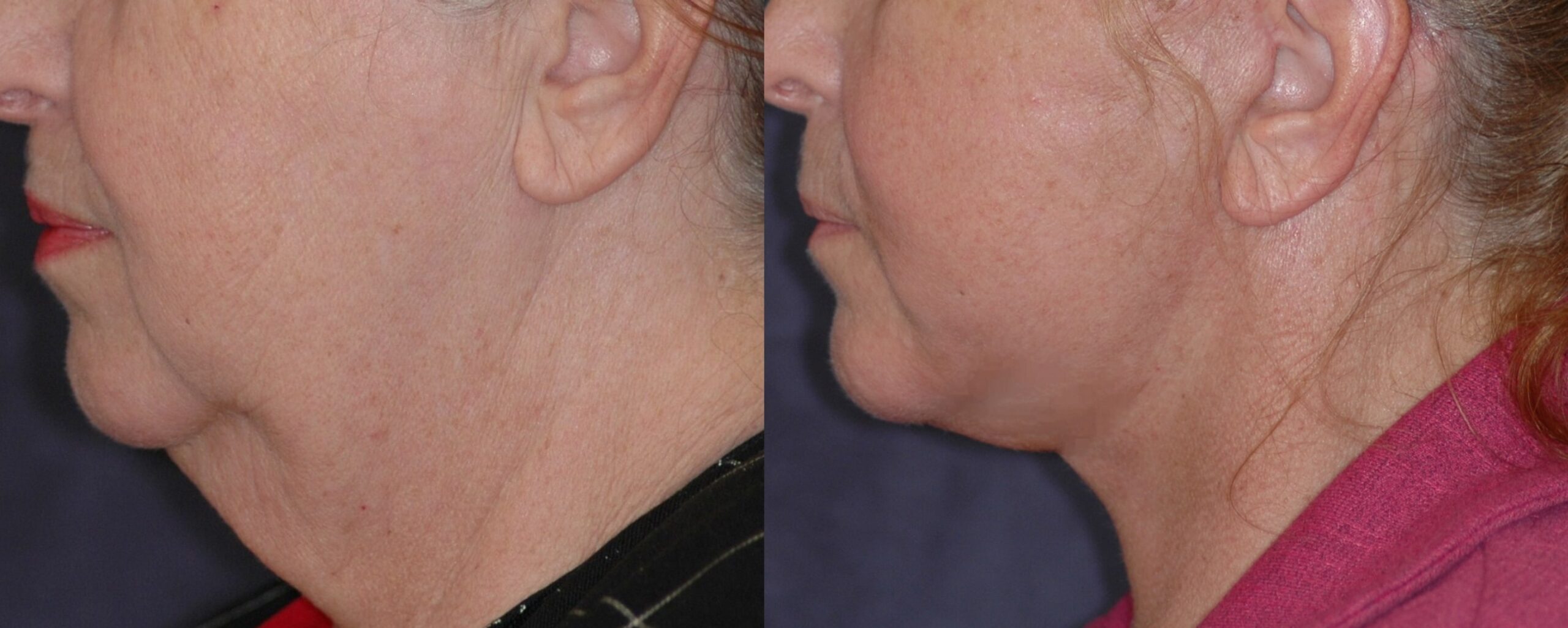 Lower Facelift - Before and after