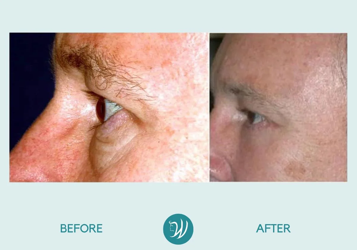 Eyelid Surgery - Before and After