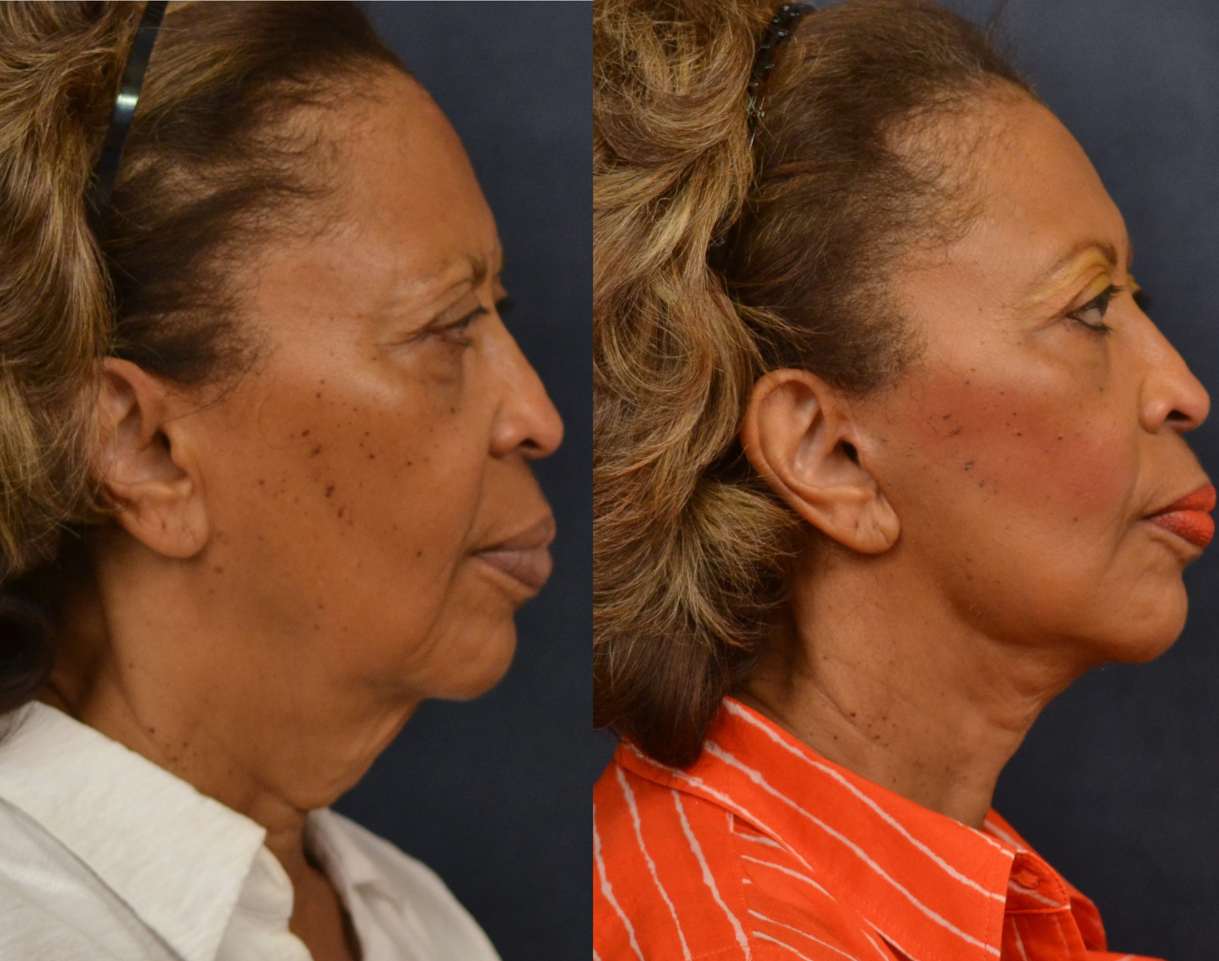 Lower Facelift before and after
