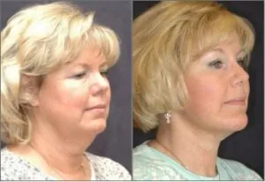 before and after photo