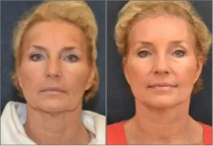 before and after photo