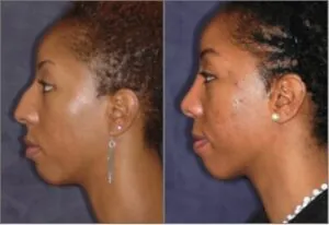 before and after photo
