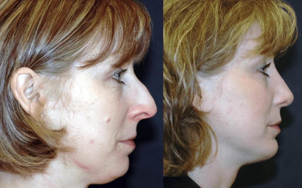 rhinoplasty-nose-surgery-before-after-patient1