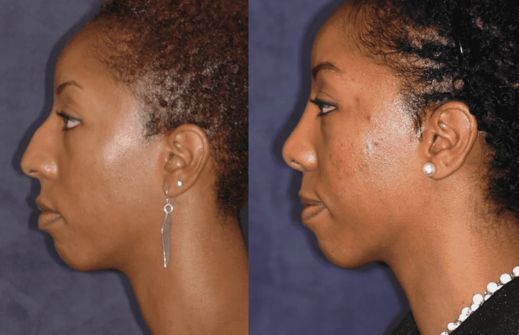 rhinoplasty-nose-surgery-before-after-patient2