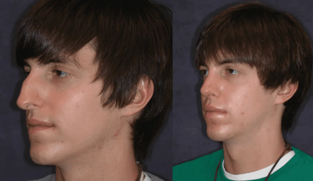 rhinoplasty-nose-surgery-before-after-patient3